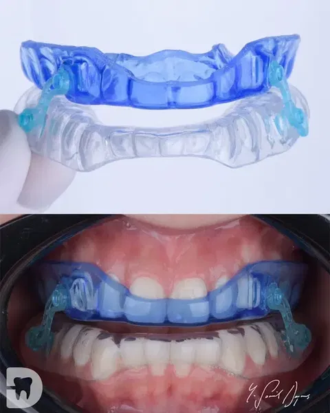 Diş Hekimi, Uzman Diş Hekimi Yusuf Şamil Doymuş, Protez Uzmanı, Prosthodontist, Протезист, İmplant, Gülüş Tasarımı - Photo 7