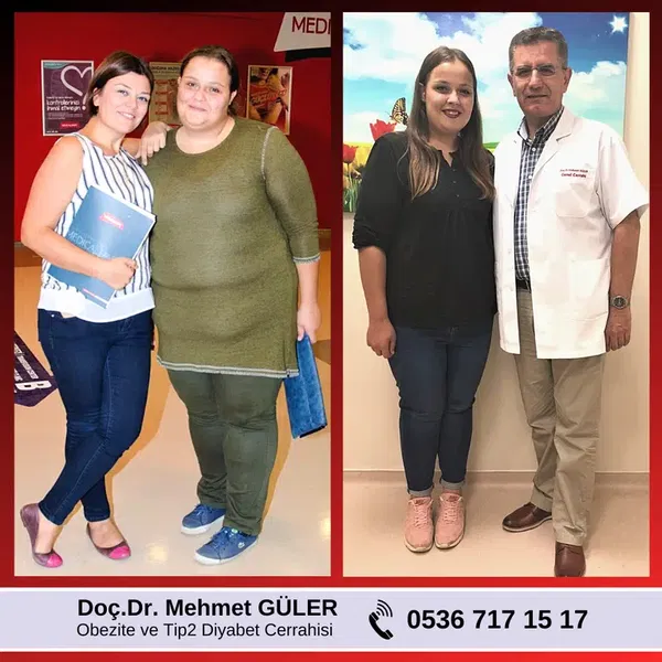 Prof. Dr. Mehmet GÜLER - Obezite ve Metabolik Cerrahi - Gastric Sleeve & Gastric Bypass - Photo 3