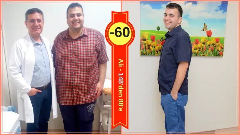 Prof. Dr. Mehmet GÜLER - Obezite ve Metabolik Cerrahi - Gastric Sleeve & Gastric Bypass - Photo 7